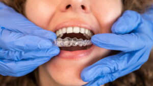 Clear aligners are custom-made for each patient at Orthoworx Chatswood and Zetland.